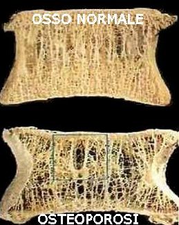 osteoporosi sport